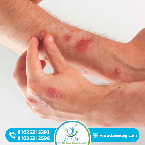 لغز التقرحات الجلدية (Xylazine Wound Disease): لماذا يتآكل الجلد؟